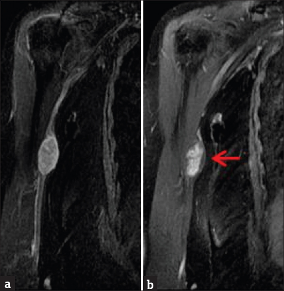 Contrast-enhanced magnetic resonance imaging of the right humerus. (a) Coronal enhanced T1-weighted sequence demonstrates a well-defined ovoid heterogeneously enhancing mass in the medial aspect of the right arm. (b) Short inversion time inversion recovery sequence demonstrates the same mass (arrow), eccentrically located in relation to the right ulnar nerve.