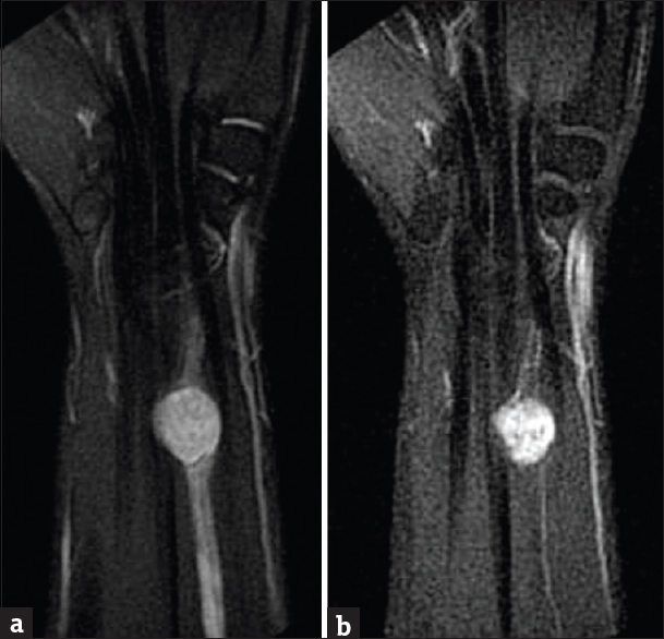 Contrast-enhanced magnetic resonance imaging of the right wrist. (a) Coronal T2-weighted sequence demonstrates round, T2 hyperintense mass just proximal to the wrist joint in close relation to the median nerve. (b) Enhanced T1-weighted images demonstrate nearly homogeneous mass enhancement.