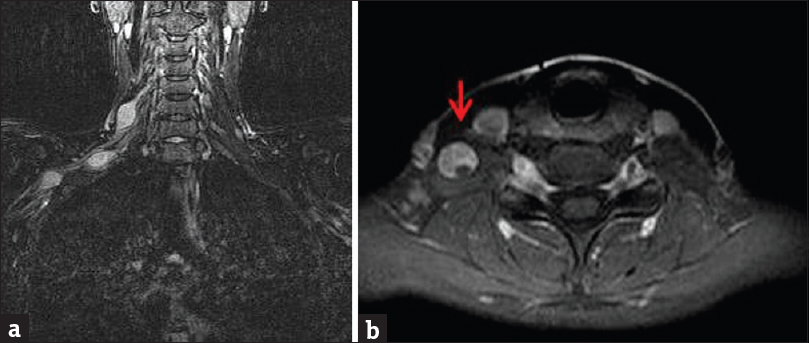 Contrast-enhanced magnetic resonance imaging of the right brachial plexus. (a) Coronal short inversion time inversion recovery sequence demonstrates several T2 hyperintense ovoid schwannomas arising from the right brachial plexus. (b) Axial enhanced T1-weighted MR images demonstrate heterogeneous mass enhancement (arrow).