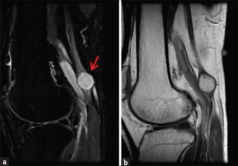 Contrast-enhanced magnetic resonance imaging of the right knee with attention to the popliteal fossa. (a) Sagittal short inversion time inversion recovery sequence demonstrates round T2 hyperintense mass closely associated with the tibial nerve (arrow). (b) Sagittal enhanced T1-weighted sequence demonstrates nearly homogeneous mass enhancement.