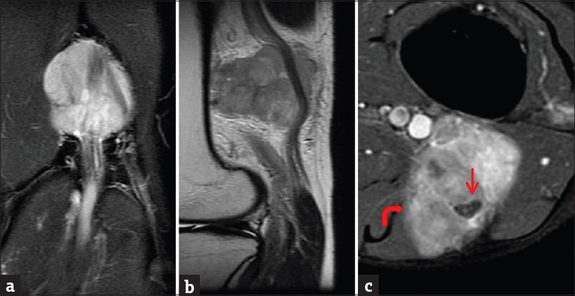 Contrast-enhanced magnetic resonance imaging of the left knee with attention to the popliteal fossa. (a) Coronal short inversion time inversion recovery sequence demonstrates large T2 hyperintense mass in the popliteal fossa. (b) Sagittal T1-weighted sequence demonstrates the T1 isointense mass closely related to the sciatic nerve. (c) Enhanced axial T1-weighted sequence demonstrates heterogeneous mass enhancement, with encasement of the sciatic nerve. Note the ill-defined medial margin (curved arrow); focal malignant degeneration was seen on histology.