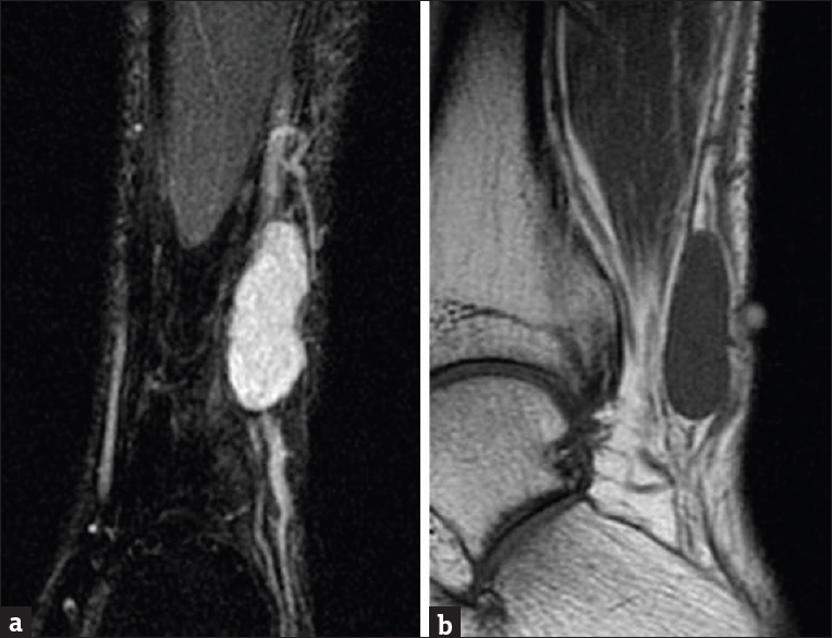 Magnetic resonance imaging of the left ankle without contrast. (a) Coronal short inversion time inversion recovery sequence demonstrates well-defined T2 hyperintense fusiform mass at the lateral aspect of the ankle closely related to the sural nerve. (b) Sagittal T1-weighted sequence demonstrates isointense T1 signal of the mass.