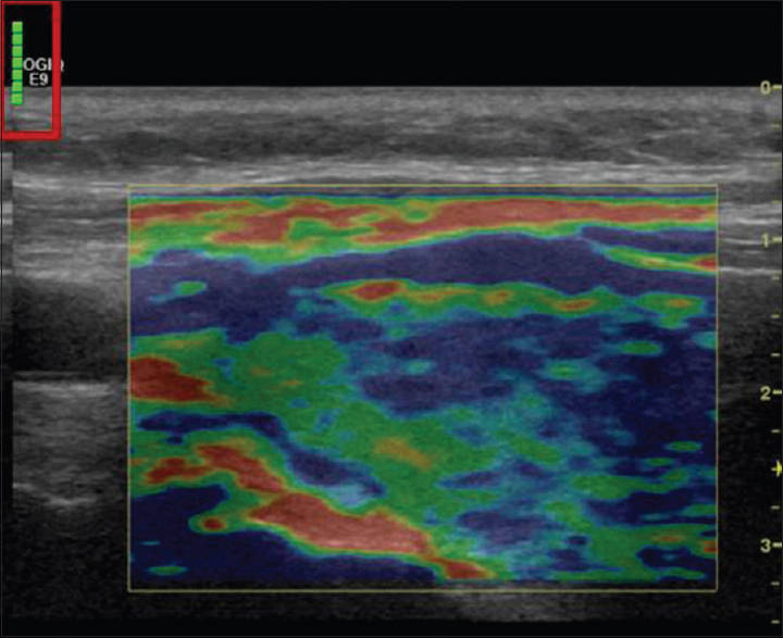 Elastogram of right thyroid lobe 3.2 cm solid nodule. Real-time applied transducer pressure analyzed by numeric scale displayed at the right upper corner of the elastogram image (red box).