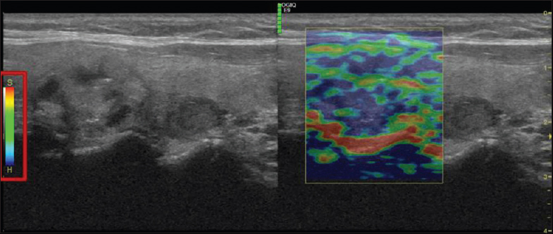 Elastogram of right thyroid lobe upper pole 2.1 cm nodule with microcalcifications. Nodule strain elastogram is displayed by a 256-color mapping scale with red representing the softest components and blue representing the hardest components.