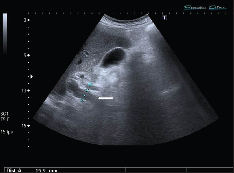 A 73-year-old man with an arteriovenous malformation of the inferior mesenteric artery; abdominal ultrasound revealed a portal vein (white arrow) in the high limit of normality (15 mm).