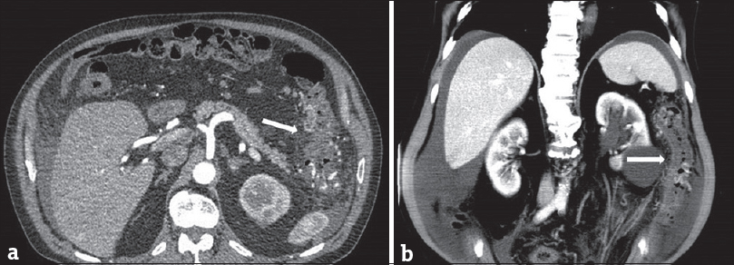 A 73-year-old man with an arteriovenous malformation of the inferior mesenteric artery; (a) transversal computed tomography scan showed wall thickening of the descending colon (white arrow). (b) Coronal image (white arrow showed wall thickening of the descending colon).