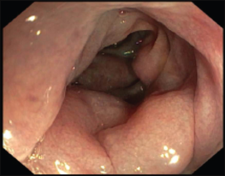 A 73-year-old man with an arteriovenous malformation of the inferior mesenteric artery; colonoscopy revealed edema in the left colon.