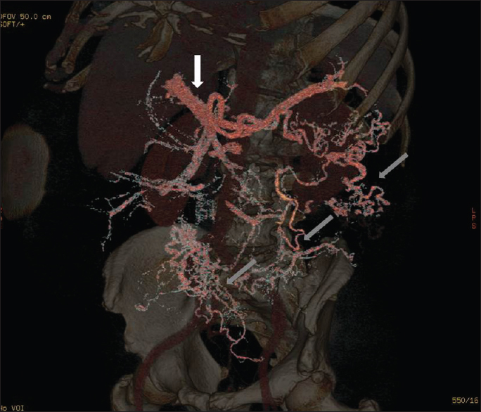 A 73-year-old man with an arteriovenous malformation of the inferior mesenteric artery; computed tomography angiography of the abdomen and pelvis confirmed a large arterial malformation involving the inferior mesenteric artery (white arrow). Gray arrows revealed abnormal vascularization.