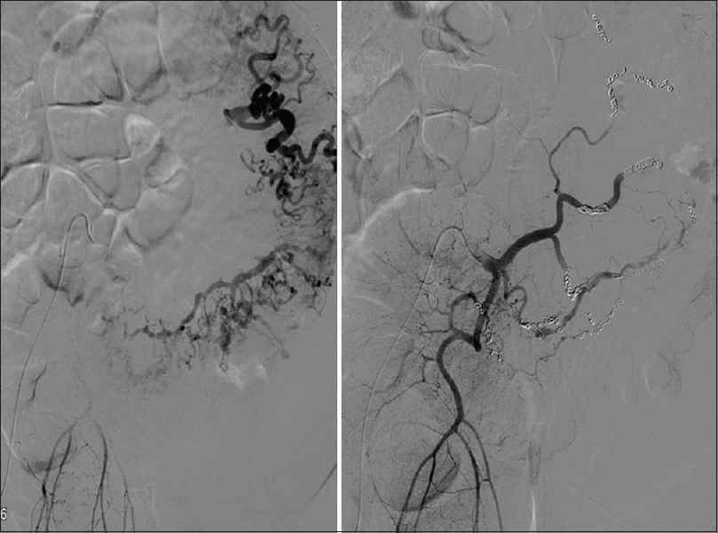 A 73-year-old man with an arteriovenous malformation of the inferior mesenteric artery; arteriography; pre-embolization image (left) and post-embolization image (right). All branches of the inferior mesenteric artery are embolized with microcoils, from the splenic angle to the sigmoid branches, respecting the territory of the upper hemorrhoidal artery.