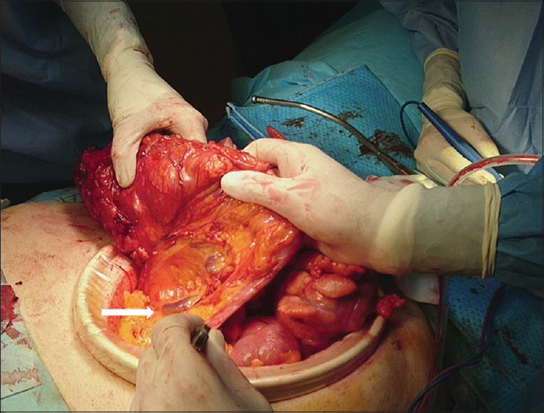 A 73-year-old man with an arteriovenous malformation of the inferior mesenteric artery; a large draining vein within the transverse mesocolon level was observed intraoperatively (white arrow).