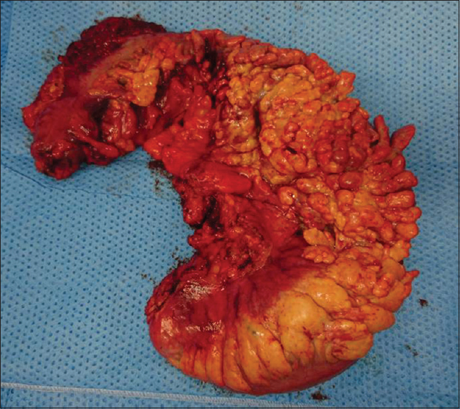 A 73-year-old man with an arteriovenous malformation of the inferior mesenteric artery; resected colon specimen.