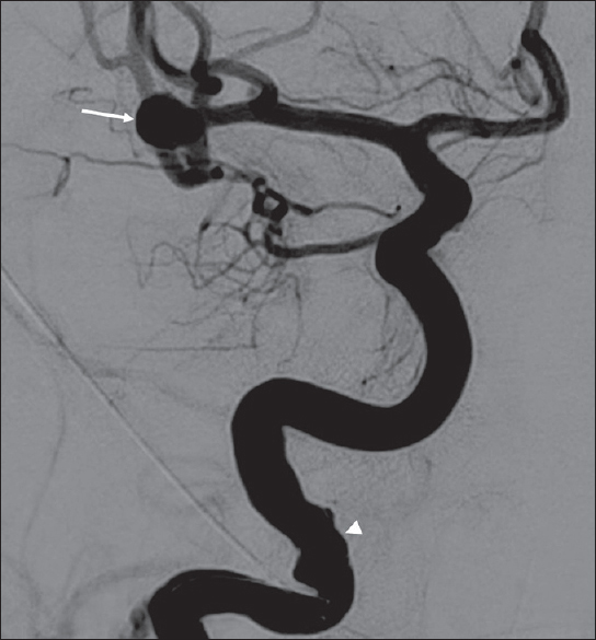 A 64-year-old woman with a ruptured wide-necked bifurcation aneurysm of the right middle cerebral artery who presented with sudden onset severe headache. Digital subtraction angiography image taken during right internal carotid artery contrast injection showing a wide-necked right middle cerebral artery bifurcation aneurysm (arrow). Note mild irregularity of the distal cervical segment of internal carotid artery due to vasospasm (arrowhead).