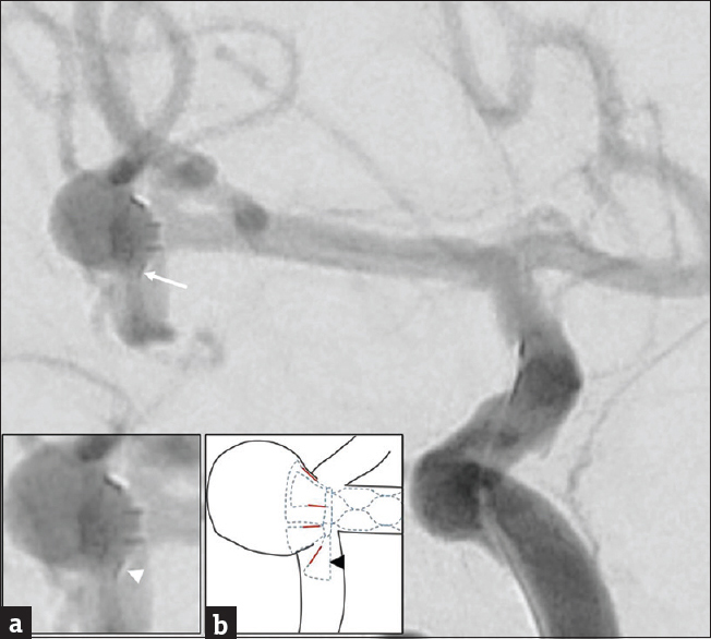 A 64-year-old woman with a ruptured wide-necked bifurcation aneurysm of the right middle cerebral artery who presented with sudden onset severe headache. Intraprocedural digital subtraction angiography during right internal carotid artery injection after deploying the pCONus device showing one petal of the device (arrow) prolapsed out of the aneurysm neck into the inferior division of middle cerebral artery. Inset (a) magnified image of the aneurysm with the deployed pCONus device, the prolapsed petal shown by arrowhead. Inset (b) schematic diagram showing approximate outlines of the aneurysm and parent vessels (black outline), the four radiopaque markers of the petals (red lines) and the position of the distal petals and stent which are not radiopaque, hence not visible in angiogram. (Blue-colored dashed shapes); the prolapsed petal is indicated by a black arrowhead.