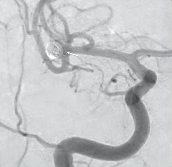 A 64-year-old woman with a ruptured wide-necked bifurcation aneurysm of the right middle cerebral artery who presented with sudden onset severe headache. Postprocedural digital subtraction angiography during right carotid artery injection showing minimal filling of the aneurysm, patent middle cerebral artery branches, and prolapse of a coil loop into the middle cerebral artery (arrow).
