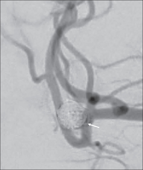 A 64-year-old woman with a ruptured wide-necked bifurcation aneurysm of the right middle cerebral artery who presented with sudden onset severe headache. Digital subtraction angiography during right internal carotid artery contrast injection, performed during the 6th month follow-up visit showing occlusion of aneurysm, persistence of prolapsed coil loop (arrow), and normal flow in the middle cerebral artery and its branches.