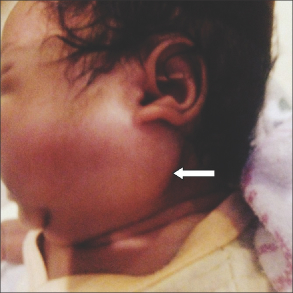 A 4-month-old infant with a history of soft-tissue swelling overlying the left angle of mandible (white arrow).