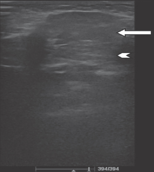 A 4-month-old infant with a history of soft-tissue swelling overlying the left angle of the mandible. Ultrasound image of the left parotid gland shows a large isoechoic lesion (white arrow) with echogenic septae within the gland (white arrowhead).