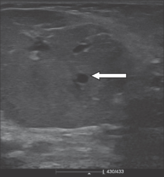 A 4-month-old infant with a history of soft-tissue swelling overlying the left angle of the mandible. Ultrasound image of the left parotid gland shows an isoechoic lesion in the parotid gland with prominent vessels within (white arrow).