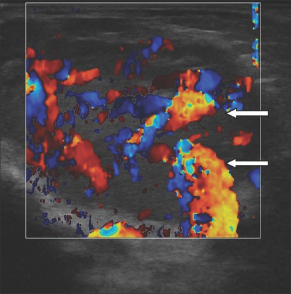 A 4-month-old infant with a history of soft-tissue swelling overlying the left angle of the mandible. Color Doppler of the left parotid gland shows multiple dilated vascular channels within the lesion (white arrows).