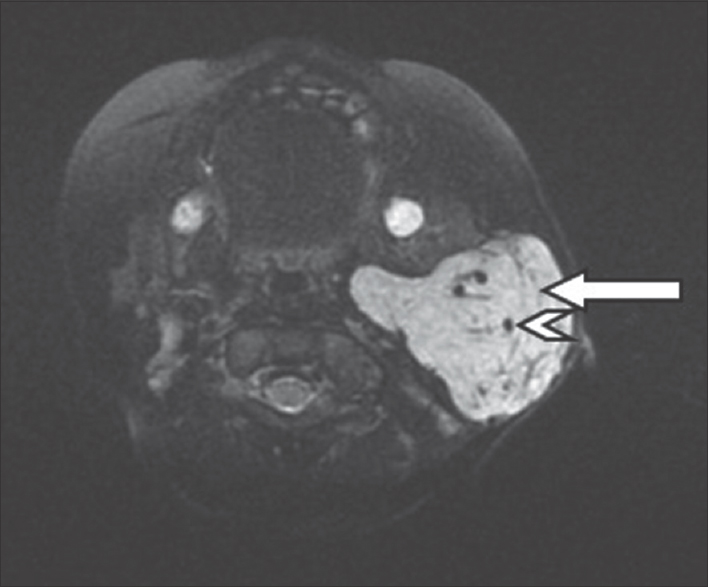 A 4-month-old infant with a history of soft-tissue swelling overlying the left angle of the mandible. Axial fat-suppressed, T2-weighted magnetic resonance imaging image of the left parotid gland shows a hyperintense lesion in the left parotid gland with few thin septae (white arrows) and flow voids within (white arrowheads).