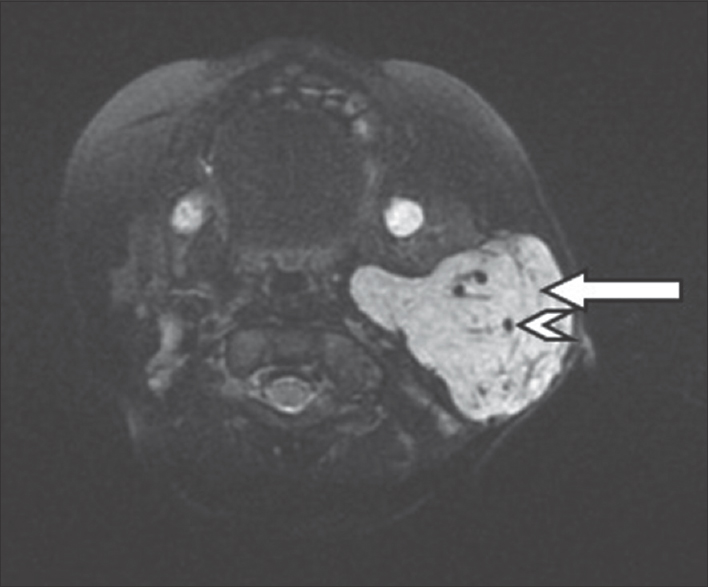 Infantile Hemangioendothelioma of the Parotid Gland - Journal of