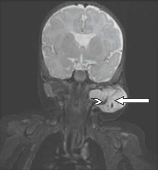 A 4-month-old infant with a history of soft-tissue swelling overlying the left angle of the mandible. Coronal short tau inversion recovery magnetic resonance imaging image of the left parotid gland shows a hyperintense lesion in the left parotid gland with few thin septae (white arrows) and flow voids within (white arrowheads).