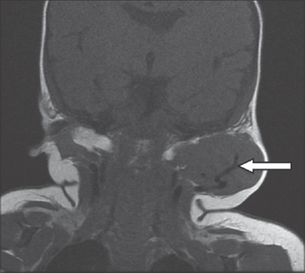 A 4-month-old infant with a history of soft-tissue swelling overlying the left angle of the mandible. Coronal T1-weighted magnetic resonance imaging image of the left parotid gland shows an isointense lesion in the left parotid gland with a flow void within (white arrow).