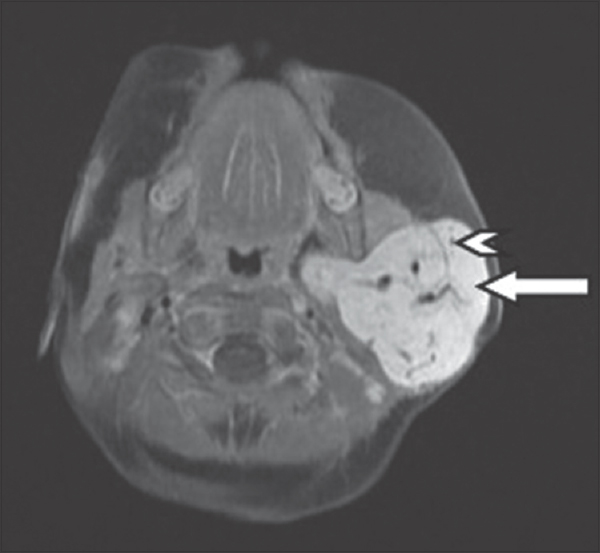 A 4-month-old infant with a history of soft-tissue swelling overlying the left angle of mandible. Contrast-enhanced T1-weighted axial magnetic resonance imaging images of the left parotid gland demonstrates homogeneous enhancement of the entire lesion (white arrows), with thin nonenhancing septae (white arrowheads).