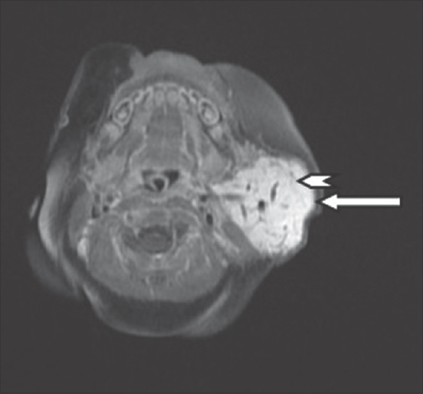 A 4-month-old infant with a history of soft-tissue swelling overlying the left angle of mandible. Another contrast-enhanced T1-weighted axial magnetic resonance imaging images of the left parotid gland demonstrates homogeneous enhancement of the entire lesion (white arrows), with thin nonenhancing septae (white arrowheads).