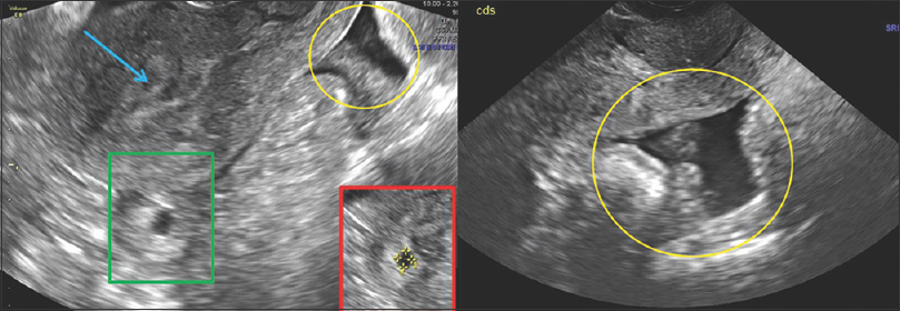 29-year-old pregnant female with last menstrual period 8 weeks ago, presented with acute onset lower abdominal pain and hypotension. Transabdominal longitudinal pelvic ultrasound image shows empty endometrial cavity (blue arrow), with a distended tubal structure (green box), posterior to the uterus. There is a moderate amount of mixed echoes in the cul-de-sac (yellow oval), consistent with clot/blood. These findings are highly suspicious for ruptured tubal pregnancy. Inset-red box shows magnified image with tubal ectopic pregnancy.