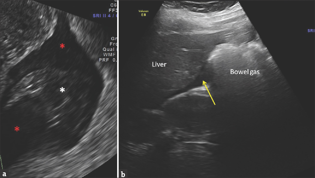 A 29-year-old pregnant female last menstrual period 8 weeks ago (same patient as Figure 1), presented with acute onset lower abdominal pain and hypotension. Magnified ultrasound image of posterior cul-de-sac (a) shows fluid with internal echoes (red asterisks) and clots (white asterisk). Fluid seen in Morrison's pouch near liver is consistent with hemoperitoneum from ruptured ectopic pregnancy (b).