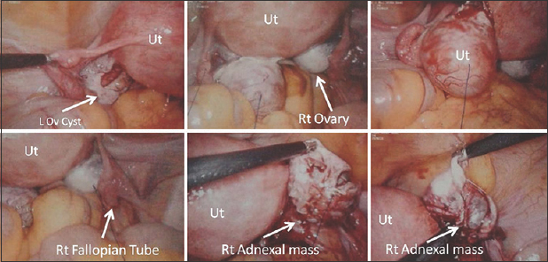 A 27-year-old female on assisted reproductive treatment. Laparoscopic images of the same patient as in Figure 11, showing the uterus, left ovarian cyst, right ovary, right fallopian tube. Right adnexal mass is shown, which was identified as right ectopic pregnancy lying just adjacent to the fimbrial end of the right fallopian tube. Patient had a viable intrauterine pregnancy. This was a surgically proven case of heterotopic pregnancy.