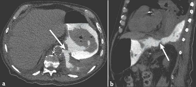 88-year-old male presents with several weeks of cough and fatigue. (a) Axial computed tomography image of the chest and abdomen after administration of dilute water-soluble oral contrast demonstrating clear extravasation of oral contrast from the stomach into the left pleural space through a large defect in the gastric wall and diaphragm (arrow). (b) Sagittal computed tomography image demonstrating similar finding (arrow).