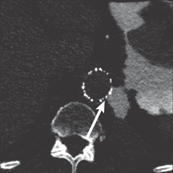 88-year-old male presents with several weeks of cough and fatigue. Axial computed tomography image of the chest after administration of dilute water-soluble oral contrast demonstrating extension of the contrast from the stomach, through the pleural space, and between the struts of the aortic vascular stent (arrow).