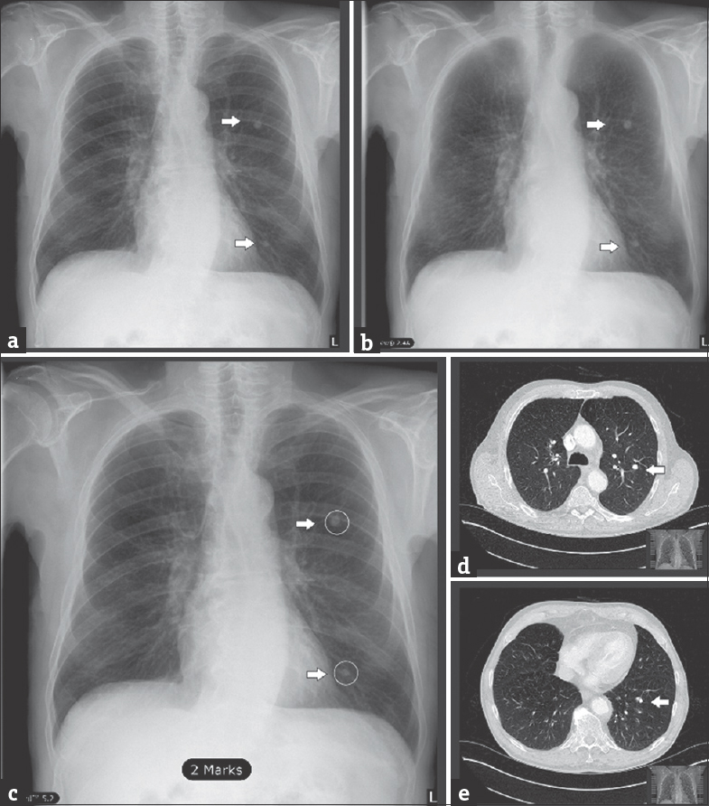 Sample images for bone suppression imaging and computer-aided detection lesion identification (a) unprocessed posteroanterior chest radiograph (CTL), (b) posteroanterior chest radiograph after bone suppression imaging, (c) posteroanterior chest radiograph with lesions as detected by computer-aided detection (white arrows and circles). (d and e) Spiral computed tomography scans in axial plane, lung-window reconstruction, confirmation of the detected lesions in a-c (white arrows).