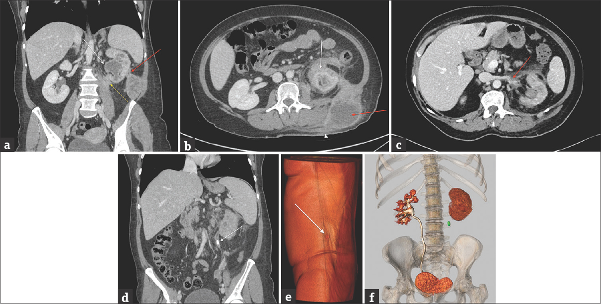 (a) Contrast-enhanced abdominal computed tomography obtained to characterize the initial ultrasound imaging findings. Contrast-enhanced abdominal computed tomography reformation in a coronal plane with soft tissue window shows the communication (red arrow) between the perinephric abscess and the posteroinferior aspect of the left kidney. Hydronephrosis (white arrow) and cortical atrophy suggest chronic obstructive uropathy. Perinephric fat infiltration extends into the left psoas muscle (yellow arrow). (b) Contrast-enhanced abdominal computed tomography in axial plane at the renal level with soft tissue window shows heterogeneous thickening adjacent to the superior pole of the left kidney, with confluent cortical abscesses and an intense inflammatory stranding of the perirenal fat (white arrow). This infiltration extends into the parietal lumbar abscess (red arrow) which fistulizes to the skin (white arrowhead). (c) Contrast-enhanced abdominal computed tomography in axial-oblique plane at the level of the left renal vein with soft tissue window shows the occlusion of the proximal aspect of this vein (red arrow), surrounded by inflammatory changes in the adjacent fat, consistent with thrombophlebitis. (d) Contrast-enhanced abdominal computed tomography reformation in the coronal plane with soft tissue window shows the obstructing left ureteral calculus (white arrow). (e) Three-dimensional volume-rendered image in coronal plane from the excretory phase of the abdominal and pelvic computed tomography shows the left lumbar ureteral calculus (green spot) and no excretion of contrast into the left collecting system. By comparison, the right collecting system is well delineated by the normal excretion of intravenously administered iodinated contrast media. (f) Three-dimensional volume-rendered abdominal computed tomography image reveals a small red spot corresponding to the nephrocutaneous fistula (white arrow) can be depicted at the level of the left dorsolumbar fluctuating mass. Based on these images and on the clinical presentation, the radiologist concludes to a nephrocutaneous fistula related to an infected urinoma secondary to an obstructing left ureteral stone and pelvicalyceal rupture.