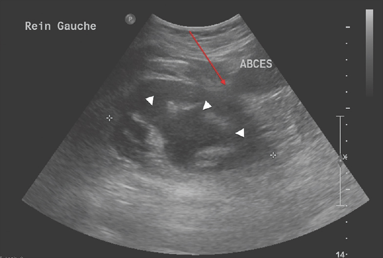 A 56-year-old woman presents to the emergency department for a left painless dorsolumbar fluctuating mass which was progressively growing over 3 months. Ultrasonography was the first imaging study obtained. A long-axis view of the left kidney shows subcutaneous and parietal multiloculated heterogeneous hypoechoic collections, compatible with abscess adjacent to the left kidney (red arrow). Moderate left hydronephrosis is also present (white arrowheads).