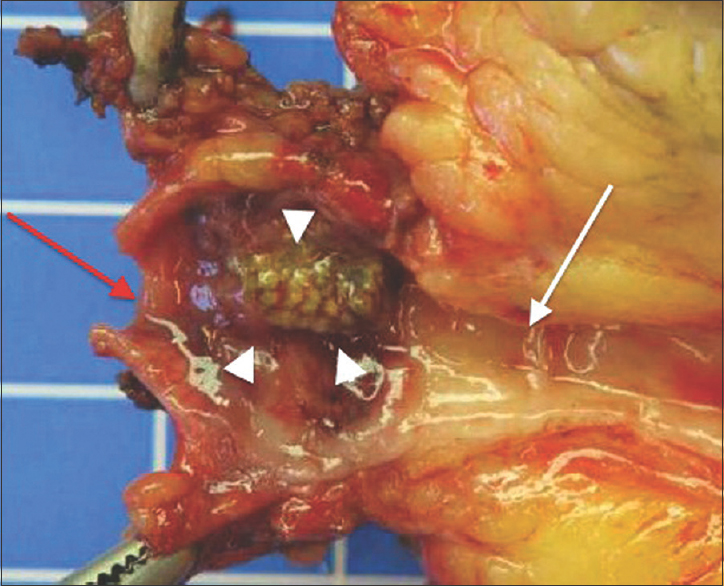 This patient undergoes a left nephrectomy for infected urinoma with nonfunctional kidney, secondary to an obstructive calculus, calyceal rupture, and nephrocutaneous fistula. A picture of the pathological specimen of the left ureter at the level of the obstruction shows a left ureteral obstruction by a conglomerate of microstones (white arrowheads). The proximal ureter (white arrow) is surrounded by an intense chronic fibroinflammatory process while the distal ureter is normal (red arrow).