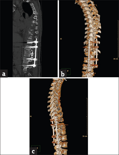 Case 1: A 42-year-old male posttraumatic vertebral fracture patient with complicated spinal instrumentation and extensive vertebral osteolysis. (a) Sagittal bone window reformat of the dorsolumbar spine using orthopedic metal artifact reduction algorithm showing the metallic implants with a clear definition of the vertebral details and minimal artifact streaks (Score 4). (b) Three dimensional computed tomography color-coded reconstruction with orthopedic metal artifact reduction, left posterior-lateral projection showing the fixing metallic rods with minimal intervening streak artifacts. (c) Three-dimensional computed tomography color-coded reconstruction with orthopedic metal artifact reduction, right posterior-lateral projection showing the extensive vertebral osteolysis with superior bone details and minimal streak artifacts.