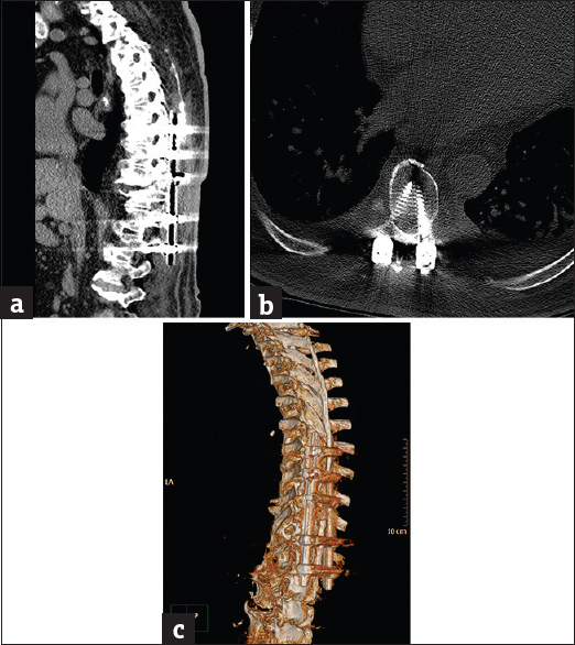 Case 2: A 66-year-old male patient with spinal instrumentation for tuberculosis. (a) Sagittal soft-tissue window reformat of the dorsolumbar spine using orthopedic metal artifact reduction algorithm showing severe image degradation with obscuring artifact streaks (Score 1). (b) Axial bone window using orthopedic metal artifact reduction algorithm showing the metallic implants with marked veiling artifacts, ill-definition of the vertebral details and failure to delineate the extent of the perispinal tuberculosis lesion. (c) Three-dimensional computed tomography color-coded reconstruction with orthopedic metal artifact reduction, left posterior-lateral projection showing marked haziness of the bony details with marked streak artifacts.