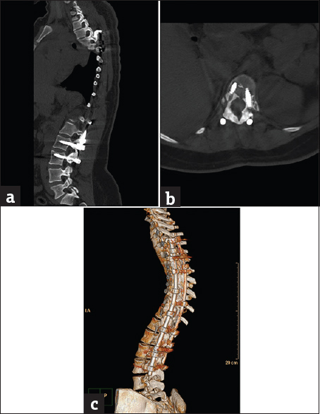 Case 3: A 27-yar-old female patient with corrective spinal instrumentation for kyphoscoliotic deformity. (a) Sagittal bone window reformat of the dorsolumbar spine using orthopedic metal artifact reduction algorithm showing excellent vertebral details with almost absence of significant obscuring artifacts (Score 5). (b) Axial bone window using orthopedic metal artifact reduction algorithm, showing the metallic implants with clear vertebral and paraspinal muscle details. (c) Three-dimensional computed tomography color-coded reconstruction with orthopedic metal artifact reduction, left posterior-lateral projection showing the whole length of the corrective implant with clear anatomical relations.