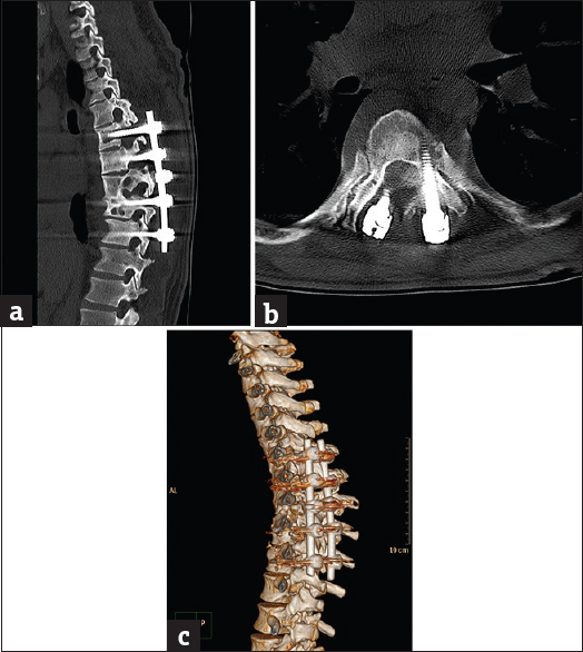 Case 4: A 33-year-old patient with post-tuberculosis spinal fixation. (a) Sagittal bone window reformat of the dorsolumbar spine using orthopedic metal artifact reduction algorithm showing excellent vertebral details with almost absence of significant obscuring artifacts (Score 5). (b) Axial bone window using orthopedic metal artifact reduction algorithm, showing the tuberculous perispinal mass with clear intraspinal extension. (c) Three-dimensional computed tomography color-coded reconstruction with orthopedic metal artifact reduction, left posterior-lateral projection showing the fixing implant with well-defined tuberculosis bone destruction.