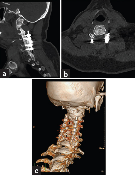 Case 5: A 36-year-old male patient with posttraumatic cervical spine fixation. (a) Sagittal bone window reformat of the cervical spine using orthopedic metal artifact reduction algorithm, showing internal fixation through a posterior approach with good vertebral details (Score 4). (b) Axial bone window using orthopedic metal artifact reduction algorithm, showing the good healing process of the vertebral fracture with no significant veiling artifacts. (c) Three-dimensional computed tomography color-coded reconstruction with orthopedic metal artifact reduction, right posterior-lateral projection showing the cervical instrumentation with satisfactory details.