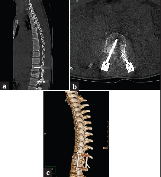 Case 6: A 22-year-old male patient with post-L1 spinal fracture fixation. (a) Sagittal bone window reformat of the dorsolumbar spine using orthopedic metal artifact reduction algorithm, showing marked posterior cortical displacement of the fractured vertebra encroaching upon the spinal canal with satisfactory bone details (Score 3). (b) Axial bone window using orthopedic metal artifact reduction algorithm, showing satisfactory bone details yet, obscured adjacent paraspinal muscles. (c) Three-dimensional computed tomography color-coded reconstruction with orthopedic metal artifact reduction, left posterior-lateral projection showing the spinal canal encroachment with satisfactory details.