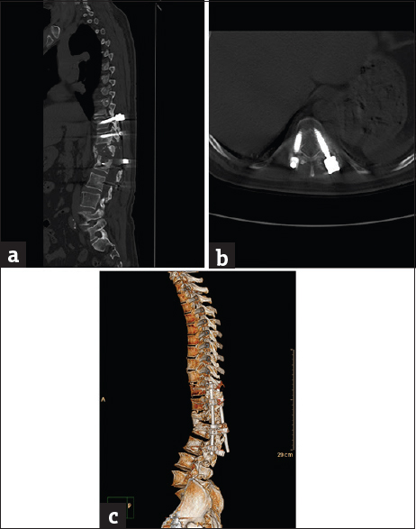 Case 7: A 55-year-old male patient with postfixation infection and hardware failure. (a) Sagittal bone window reformat of the dorsolumbar spine using orthopedic metal artifact reduction algorithm, showing marked loosening of the lower fixing pedicular screws with evident displacement and extensive osteolysis (Score 4). (b) Axial bone window using orthopedic metal artifact reduction algorithm showing the relation between the detached screws and the related vertebra. (c) Three-dimensional computed tomography color-coded reconstruction with orthopedic metal artifact reduction, left posterior-lateral projection showing the evident hardware failure and vertebral destruction.