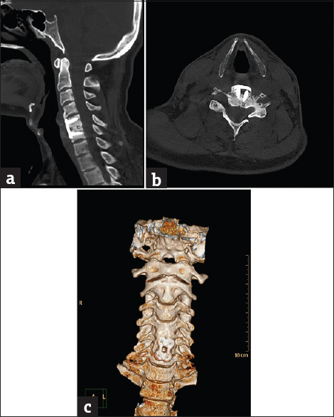 Case 8: A 26-year-old female patient with nonunited vertebral fracture. (a) Sagittal bone window reformat of the cervical spine using orthopedic metal artifact reduction algorithm showing very clear details of the anterior spinal fixation (Score 5). (b) Axial bone window using orthopedic metal artifact reduction algorithm showing the gapping nonunited fractured posterior neural arch with the almost total absence of veiling artifacts. (c) Three-dimensional computed tomography color-coded reconstruction with orthopedic metal artifact reduction, anterior projection showing the good cervical alignment despite the nonunited fracture.