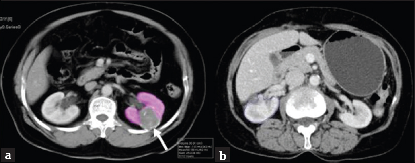 Contrast-enhanced computed tomography of patient with renal mass. (a) Contrast enhancing computed tomography image at the level of kidney shows well defined hypoenhancing mass (arrow) at mid pole of the left kidney with volume estimation of rest of the normal kidney. (b) Contrast enhancing computed tomography image at the level of kidney shows well enhancing renal parenchyma of the right kidney following partial nephrectomy.
