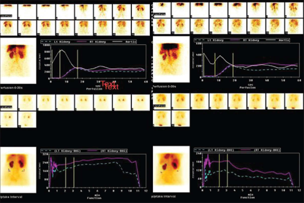 Technetium Tc 99m-diethylenetriaminepentaacetic acid (Tc 99m-diethylene triamine pentaacetic acid) scan. Pre- and post-operative scan showing good perfusion and uptake by both kidneys (Gates method). In upper part of figure, white line shows aortic blood flow and violet and green (broken) lines shows right and left renal flow (perfusion) respectively. In lower part of figure violet and green (broken) lines shows right and left kidney excretion (function), respectively.