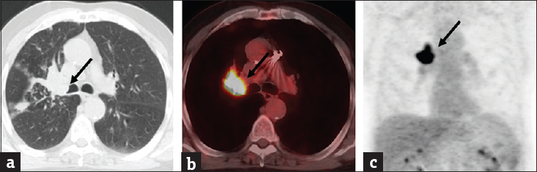 A 71-year-old man with right upper lobe T3N1M0 squamous cell carcinoma. (a) Axial computed tomography images in lung and soft-tissue windows showing an obstructive right hilar mass lesion with an endobronchial component at the origin of the right upper lobe bronchus (arrow). (b and c) Axial and coronal positron emission tomography/computed tomography images showing avid F-18 fluorodeoxyglucose uptake with the mass (arrow).