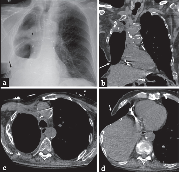 (a and b) Chest X-ray and coronal computed tomography reformation demonstrating the right pectoralis muscle flap (*) and Clagett window (arrow). (c and d) Axial computed tomography images again showing the right pectoralis muscle flap (*) and Clagett window.